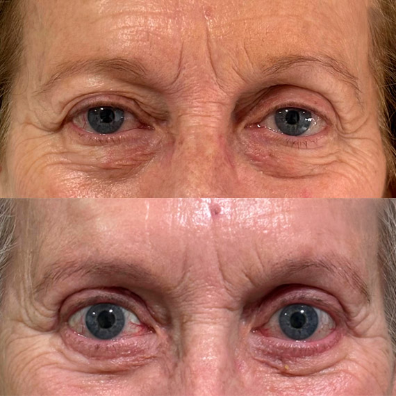 antes despues ptosis palpebral malaga 2