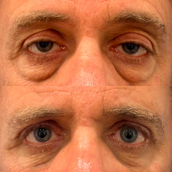 antes despues ptosis palpebral malaga 3
