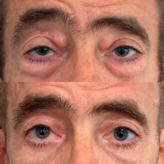 antes despues ptosis palpebral malaga 4