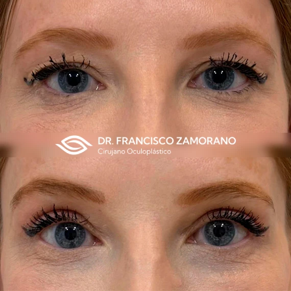 blefaropalstia superior malaga resultados