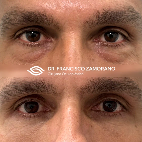 Blefaroplastia inferior transconjuntival malaga resultados