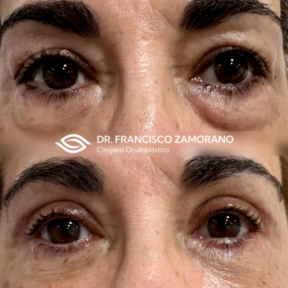 Blefaroplastia superior e inferior