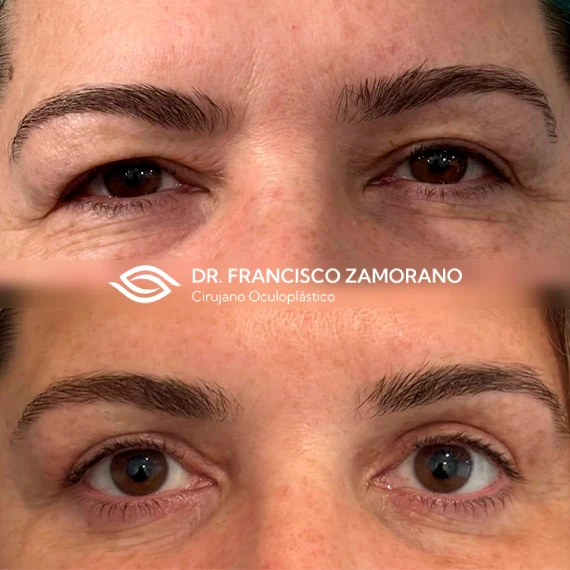 Blefaroplastia superior resultados