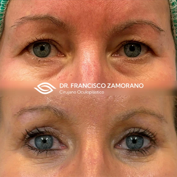 blefaroplastia en malaga superior e inferior transconjuntival