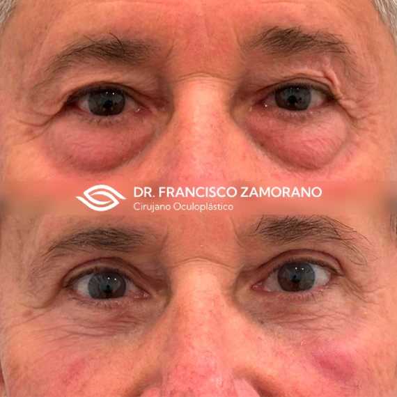 resultados blefaroplastia completa transconjuntival malaga