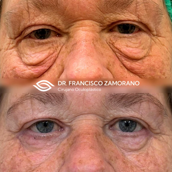 blefaroplastia malaga inferior con corrección de festón malar
