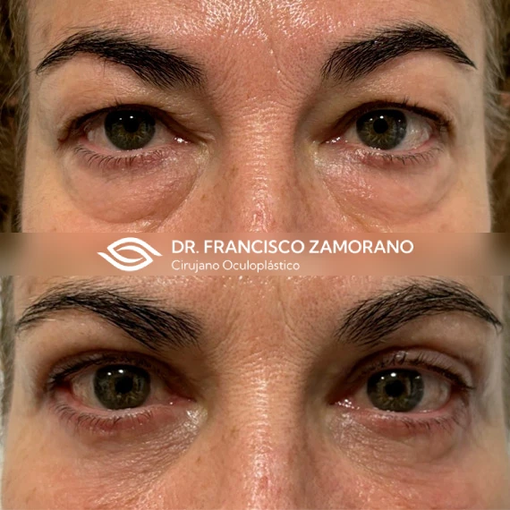 resultados blefaroplastia completa con corrección de festón malar