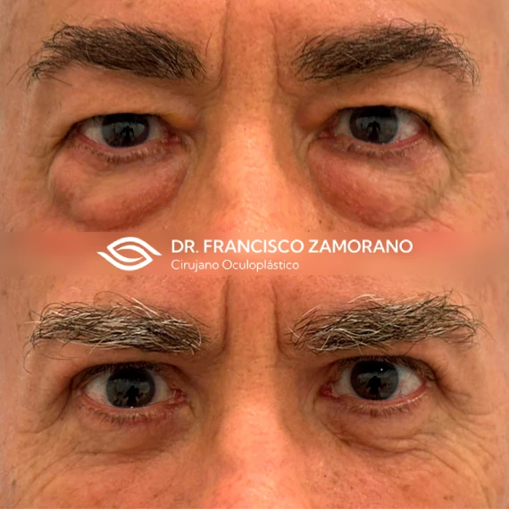 antes despues blefaroplastia malaga 6