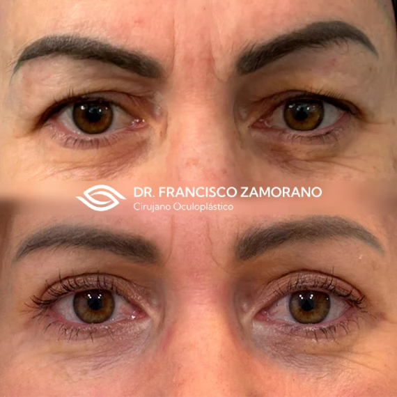 resultados de blefaroplastia superior en malaga en mujer