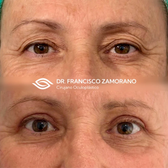 Blefaroplastia superior y Láser CO2 en malaga