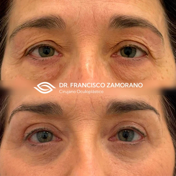 blefaroplastia completa malaga y elevación de cejas