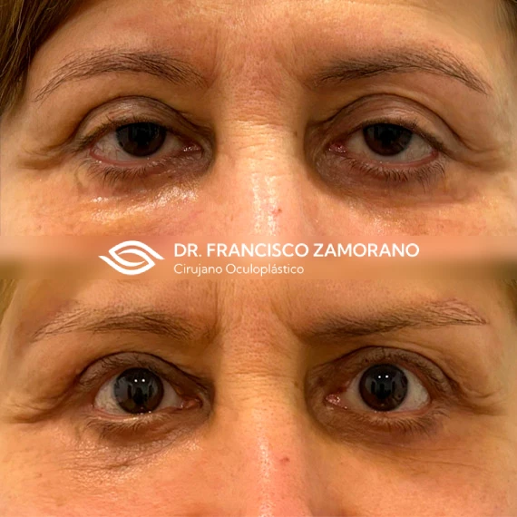 Ptosis palpebral y eliminación de lipofilling