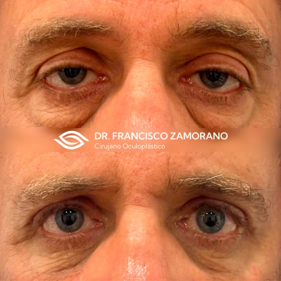 antes despues ptosis palpebral malaga 3